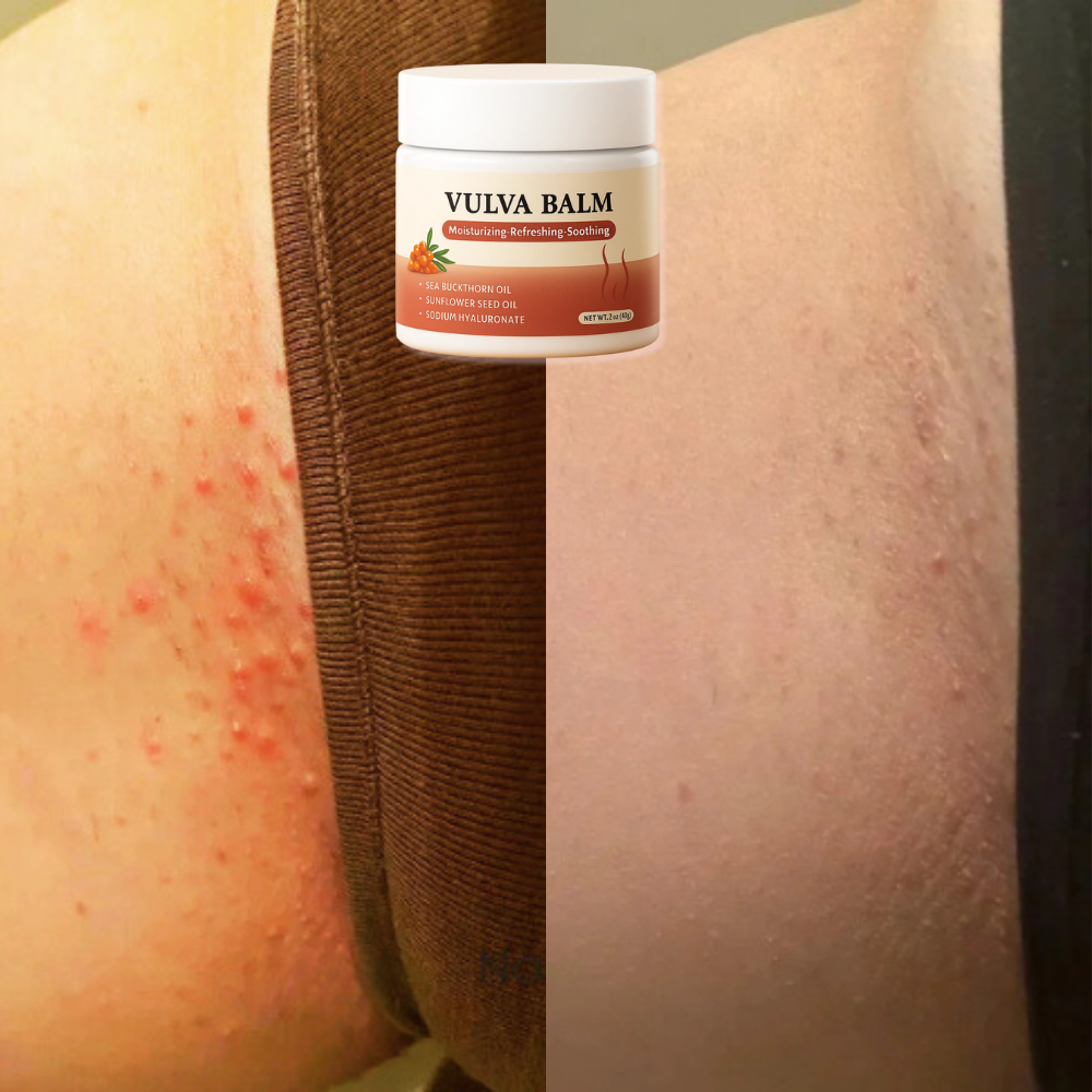 NightSkin™ Natural Vaginal Relief Balm – Doctor Approved Night-Time Care for Itching, Burning & Dryness | Hormone-Free & Organic for Sensitive Skin